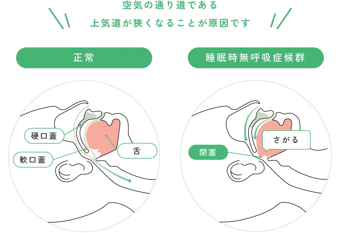 いびきと無呼吸のしくみ